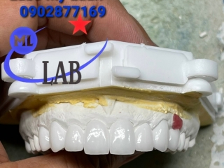 Phục Hình Răng Sứ Zirconia