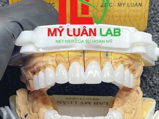 Phục Hình RĂNG SỨ CERAMILL ZOLID