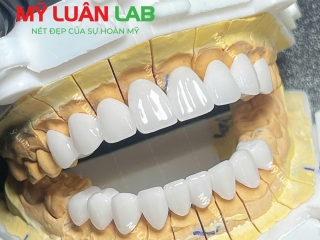 Phục Hình Răng Sứ Zirconia