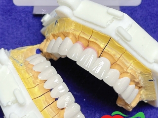 PHỤC HÌNH SỨ HT SMILE