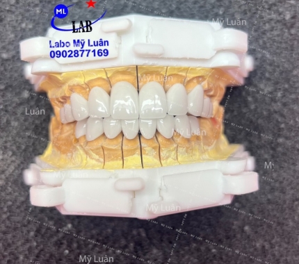 Một  ca sứ HT SMILE vừa hoàn thành cho bệnh nhân.