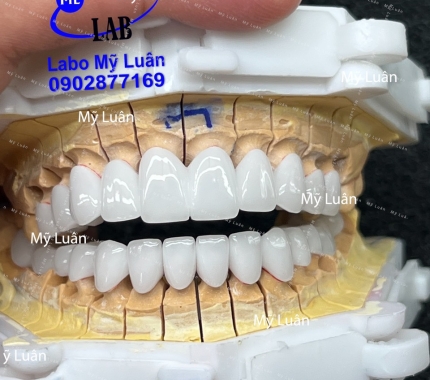 Trả răng đẹp cho khách ạ.