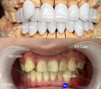 Răng khểnh đẹp tự nhiên, phục hình từ răng thật của bệnh nhân luôn nha quý khách. Kính chúc quý khách hàng thứ năm vui vẻ >.<