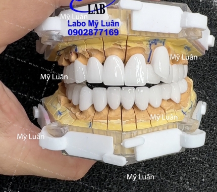 Mẫu phục hình răng khểnh tự nhiên dành cho khách yêu ạ 