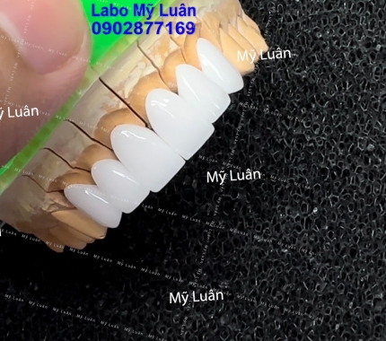 Răng sứ là giải pháp tuyệt vời để "khai thác" hết tiềm năng nụ cười của bạn