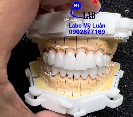 Trả răng đẹp cho khách ạ. Thứ 4 vui vẻ