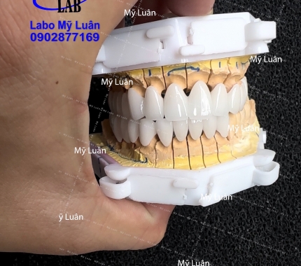 Trả răng đẹp lại cho khách, sứ DDBIO  màu 0M1 trong nha quý khách. hi