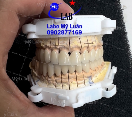 sứ cercon màu 1M1 nha quý khách