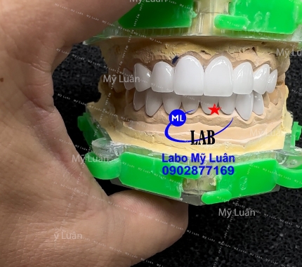 Mặt dán nha quý khách, ít xâm lấn nướu ạ hi