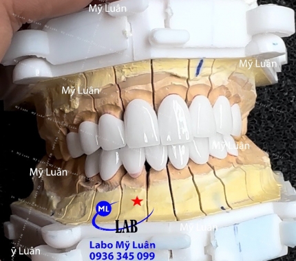 Sứ cercon màu tự nhiên vừa được hoàn thành cho khách ạ