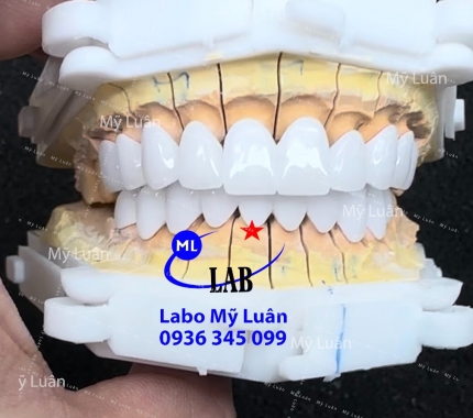 Một hàm thẩm mỹ được bác sĩ yêu cầu là không thùy , siêu láng bóng ạ