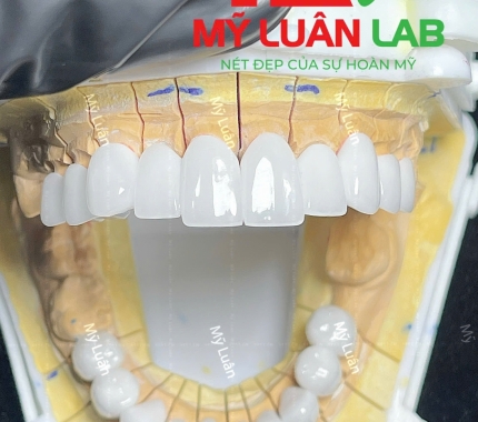 Răng sư thẩm mỹ LAB MỸ LUÂN