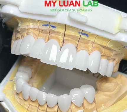 Trãi nghiệm tuyệt vời cùng Răng sứ MỸ LUÂN LAB.