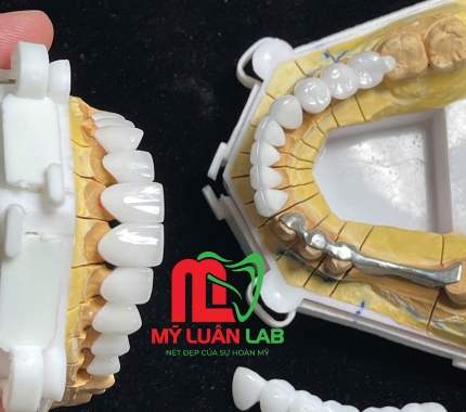 Thanh Bar trợ lực dành cho phục hình bị mất nhiều răng.